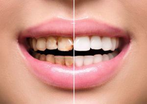 a before and after of a smile improved with cosmetic dentistry