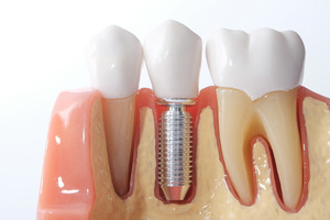 Close-up of a model of a dental implant